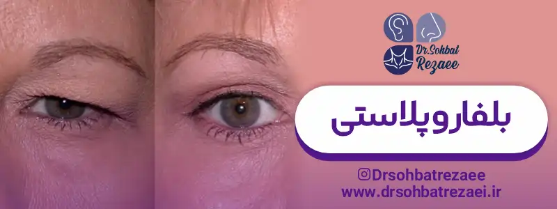 عمل بلفاروپلاستی در کرمانشاه