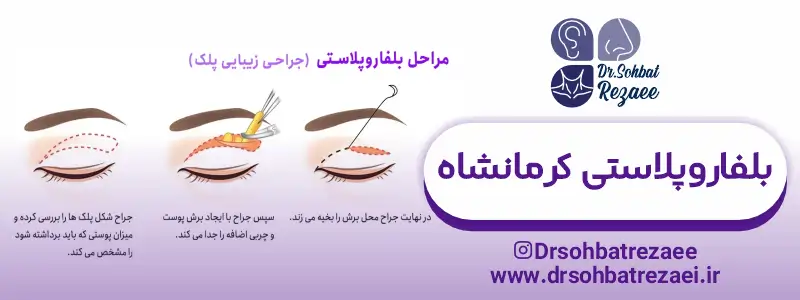 مراحل بلفاروپلاستی کرمانشاه