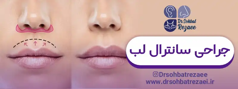 جراحی سانترال لب