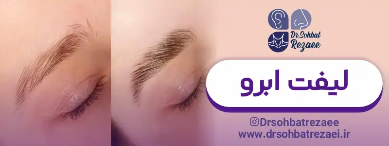 جراحی لیفت ابرو