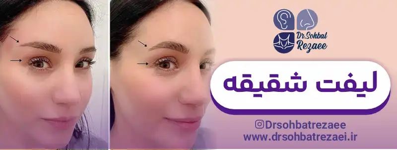 بهترین جراح لیفت شقیقه در کرمانشاه