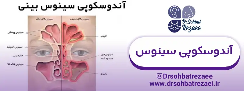 آندوسکوپی سینوس کرمانشاه