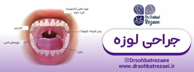 جراحی لوزه