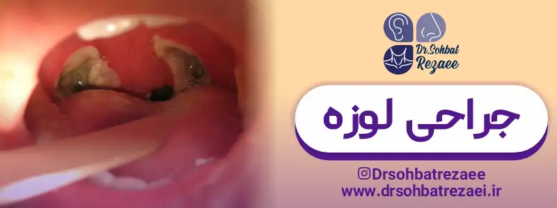جراحی لوزه