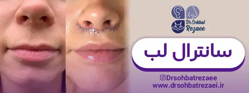 سانترال لب قبل و بعد