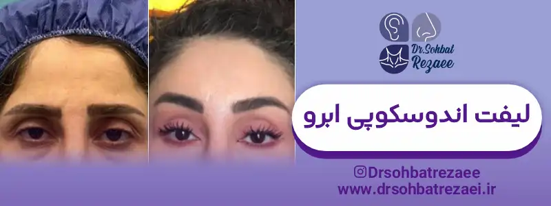 عکس نمونه لیفت اندوسکوپی ابرو