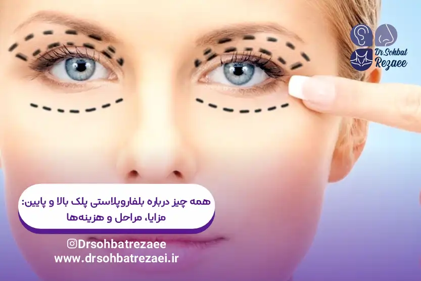 همه چیز درباره بلفاروپلاستی پلک بالا و پایین