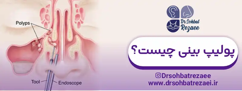 پولیپ بینی چیست