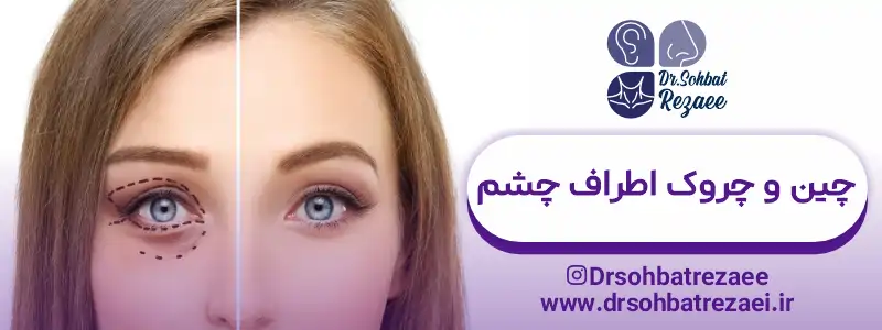 چین و چروک اطراف چشم