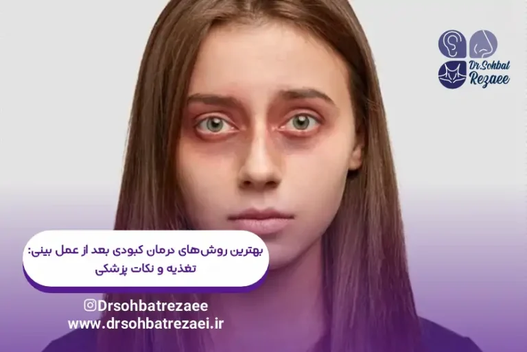 بهترین روش رفع کبودی بعد از عمل بینی تغذیه و نکات پزشکی