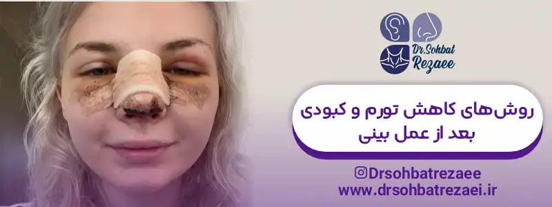 روش های کاهش تورم و کبودی بعد از عمل بینی