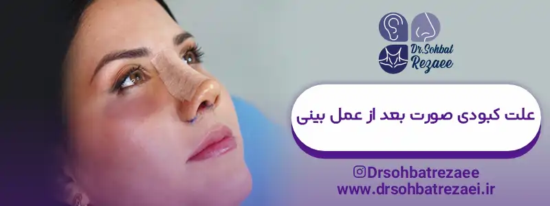 علت کبودی صورت بعد از عمل بینی