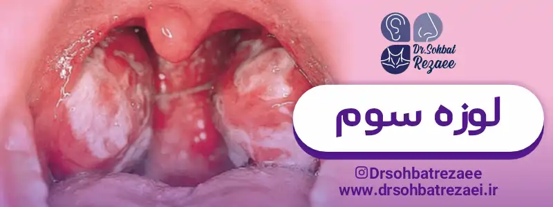 عکس لوزه سوم