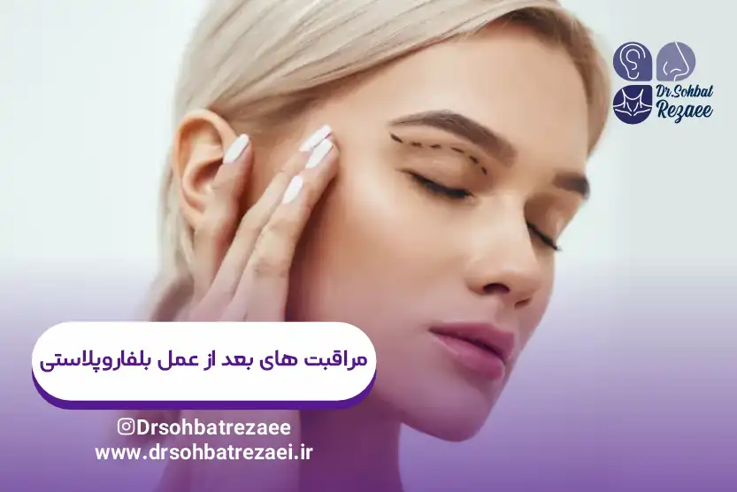مراقبت های بعد از عمل بلفاروپلاستی