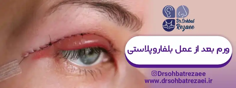 ورم بعد از عمل بلفاروپلاستی