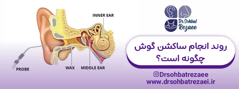 روند انجام ساکشن گوش چگونه است