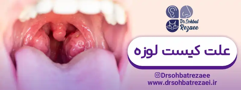 علت کیست لوزه چیست؟