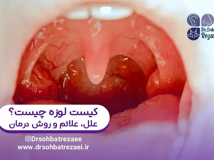 کیست لوزه چیست؟ علل، علائم و روش درمان | عکس کیست لوزه