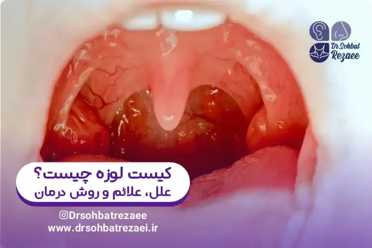 کیست لوزه چیست؟ علل، علائم و روش درمان | عکس کیست لوزه
