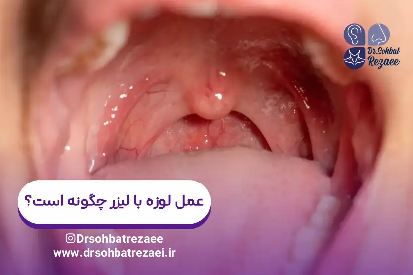 عمل لوزه با لیزر چگونه است؟