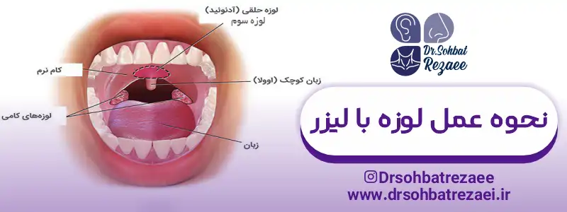 نحوه عمل لوزه با لیزر