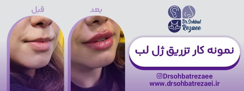 نمونه کار تزریق ژل لب در کرمانشاه
