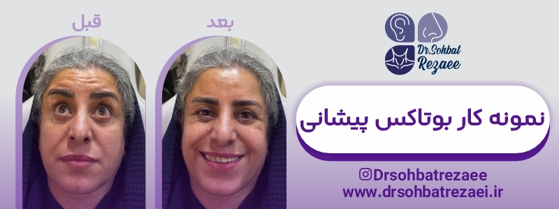 نمونه کار بوتاکس پیشانی 2