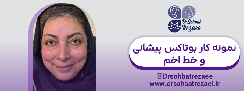 نمونه کار بوتاکس پیشانی و خط اخم