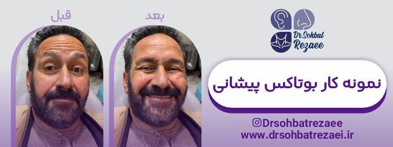 تزریق بوتاکس پیشانی در کرمانشاه