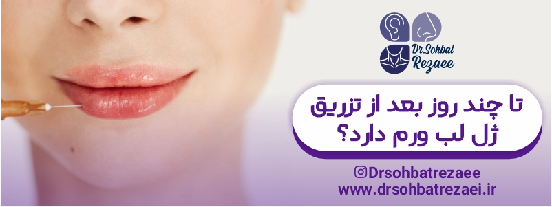 تا چند روز بعد از تزریق ژل لب ورم دارد؟