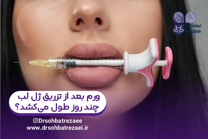 ورم بعد از تزریق ژل لب چند روز طول میکشد؟