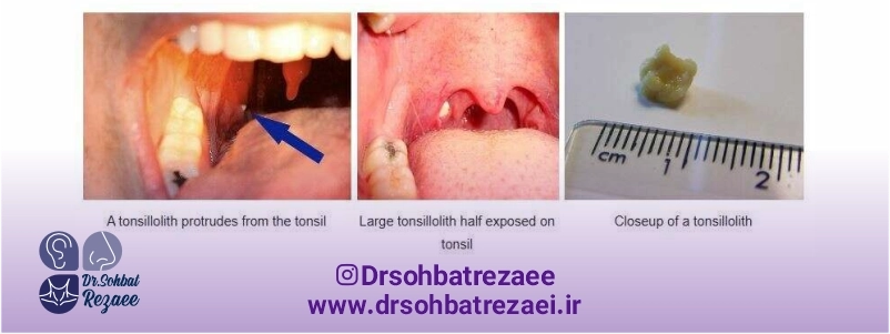 عکس واضح اندازه سنگ لوزه