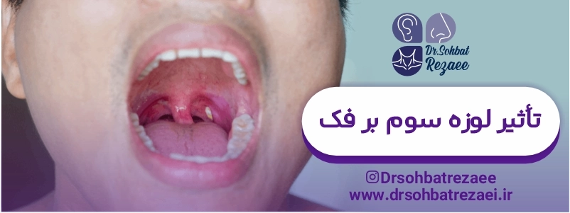 تأثیر لوزه سوم بر فک