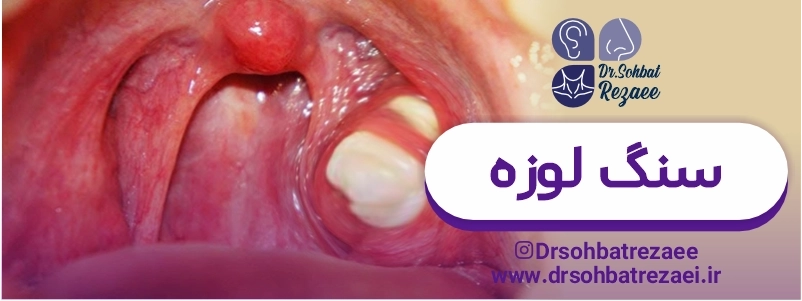 عکس سنگ لوزه